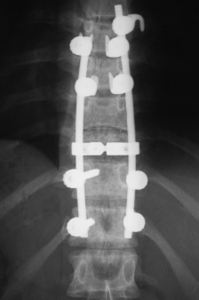 Photo of spinal cord injury